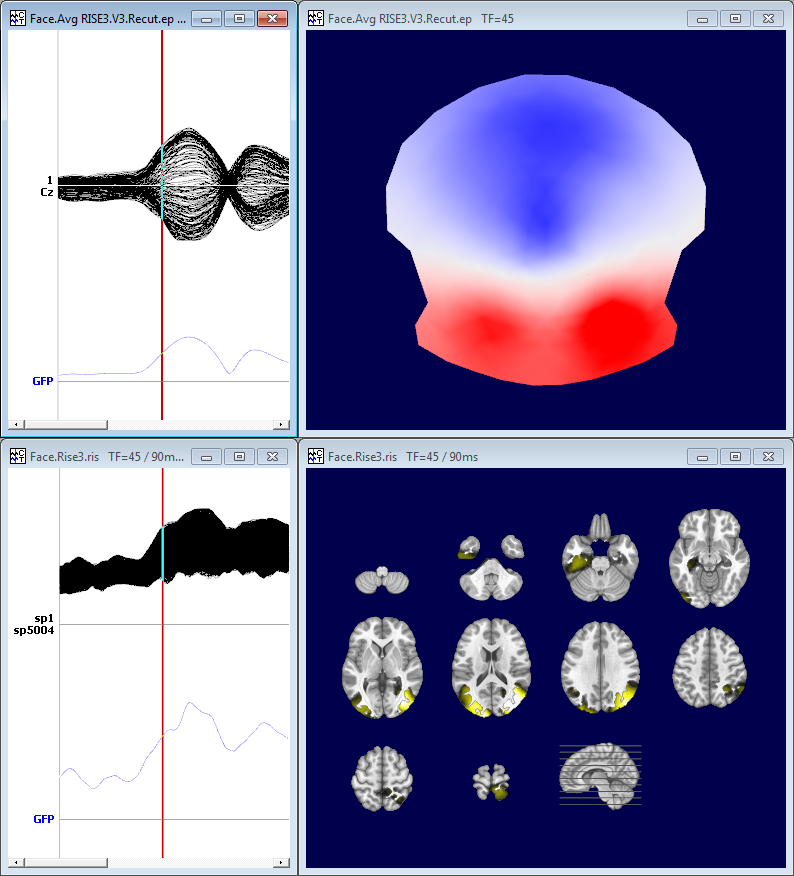 EEG vs RIS display